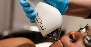 Sciton MOXI Laser Treatment in Allen, TX