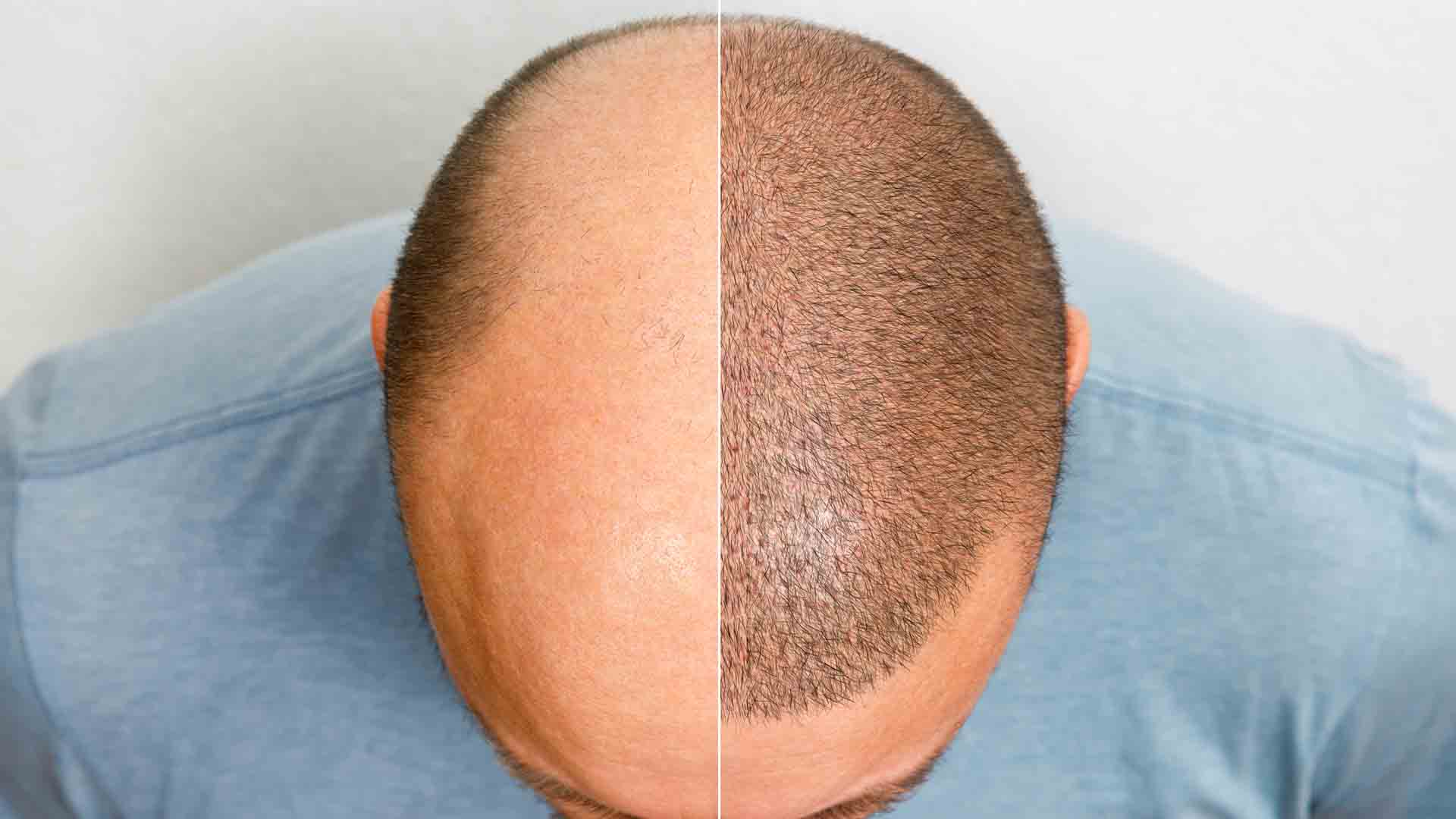 Hair restoration in Allen, Tx